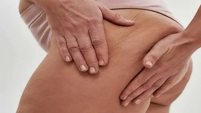 Fisioterapia Dermatofuncional - Fisioterapia Barón Móstoles