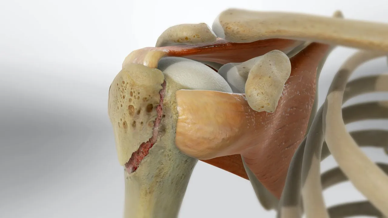 Rehabilitación fractura de húmero - Fisioterapia Barón, Móstoles